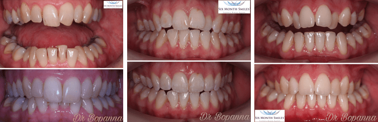 CLEAR-FIXED-BRACES